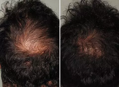Hair Loss Patient 08