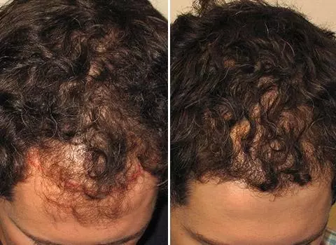 Hair Loss Patient 10