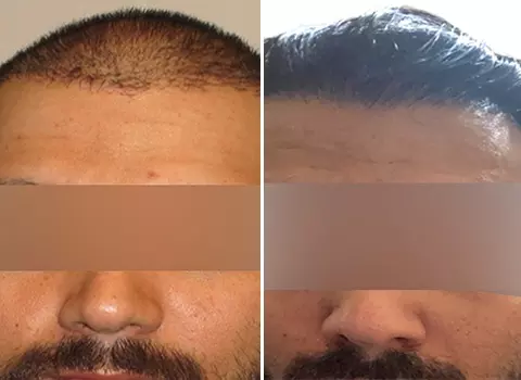 Hair Loss Patient 11