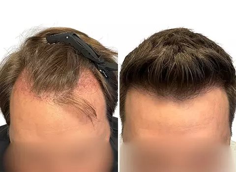 Hair Loss Patient 14