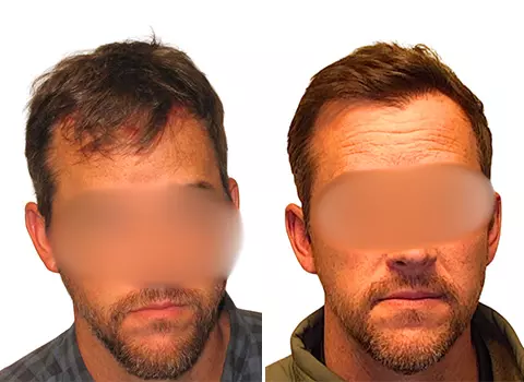 Hair Loss Patient 16