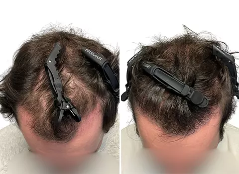 Hair Loss Patient 17