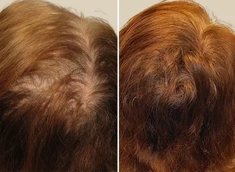 Hair Loss Patient 19
