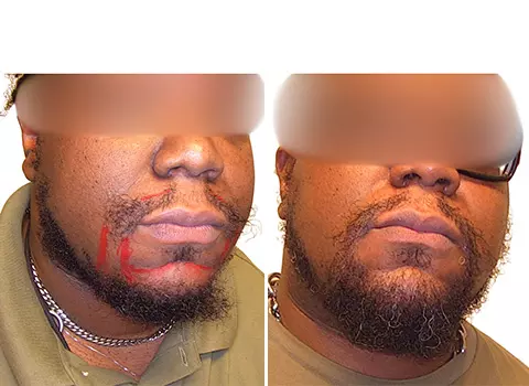 Hair Loss Patient 19