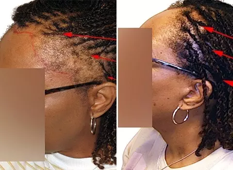 Hair Loss Patient 20