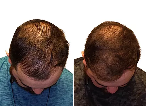 Hair Loss Patient 20
