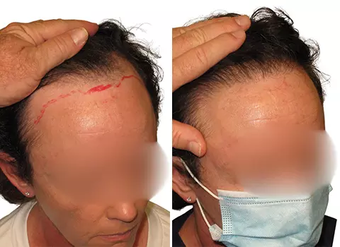 Hair Loss Patient 21