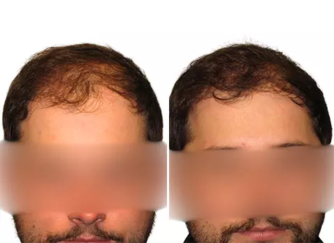 Hair Loss Patient 21