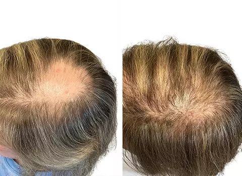Hair Loss Patient 22