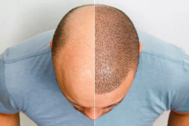 Head of a balding man before and after hair transplant surgery